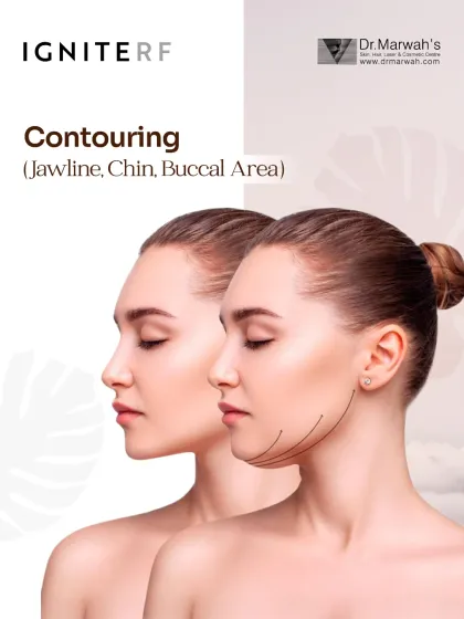 This image demonstrates the contouring capabilities of Ignite RF on the lower face. The treatment is highly effective for defining the jawline, reducing submental fat under the chin, and sculpting the buccal area for a more refined and youthful facial structure.