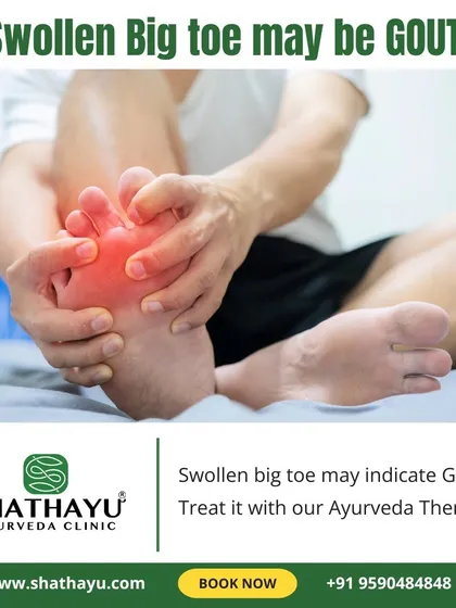 A swollen big toe can be a sign of Gout, which is caused by high uric acid levels. I offer effective Ayurvedic therapies to treat the joint inflammation and acute pain associated with this condition.