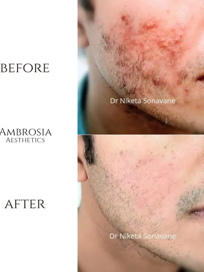 This before-and-after showcases a significant reduction in active acne and inflammation. My customized treatment plans focus on healing the skin from within to achieve clear, healthy, and long-lasting results.
