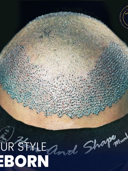 This is where science meets style. A detailed view of newly implanted hair follicles, showcasing the meticulous process of high-density hair restoration.