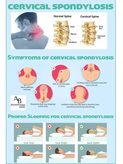 A detailed look at cervical spondylosis, or arthritis of the neck. We help manage symptoms with pain relief modalities, exercises, and advice on proper sleeping posture.