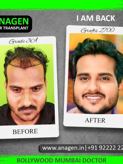 "I am back." This patient's confident smile says it all. After a 2700 graft transplant for Grade 3A baldness, he has a full, natural hairline and a renewed sense of self.
