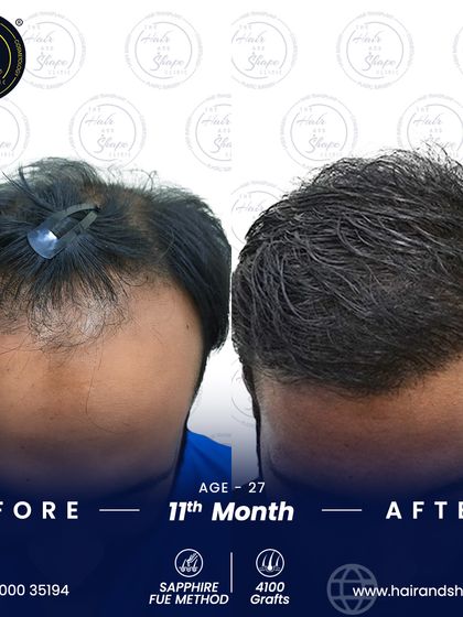This top-down angle highlights the excellent coverage and density achieved across the scalp 11 months after the Sapphire FUE procedure.