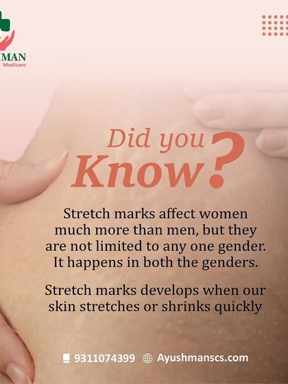 Did you know stretch marks affect both men and women? This graphic busts the myth that they are exclusive to one gender and explains they occur when skin stretches or shrinks quickly.