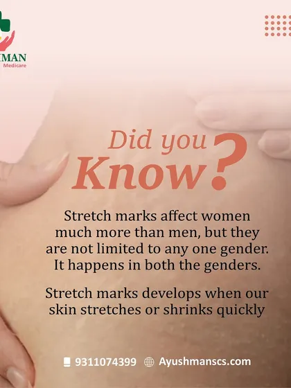 Did you know that stretch marks can affect both men and women? This informational post debunks common myths and explains that these marks develop when our skin stretches or shrinks quickly. We offer treatments to reduce their appearance.