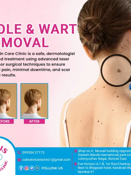 This graphic showcases the results of our mole and wart removal treatments. By using advanced laser and minor surgical techniques, we achieve clear skin for our patients with minimal pain, downtime, and reduced scarring.