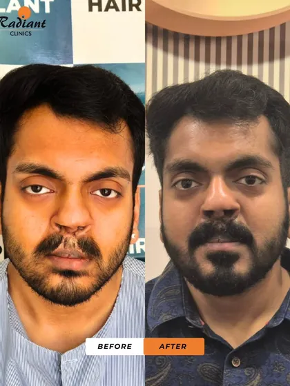 Here you can see a direct before and after comparison for the same patient. We successfully filled in the patchy areas on his lower beard and created a full, natural-looking moustache over the difficult scar tissue on his upper lip using a targeted FUE transplant.