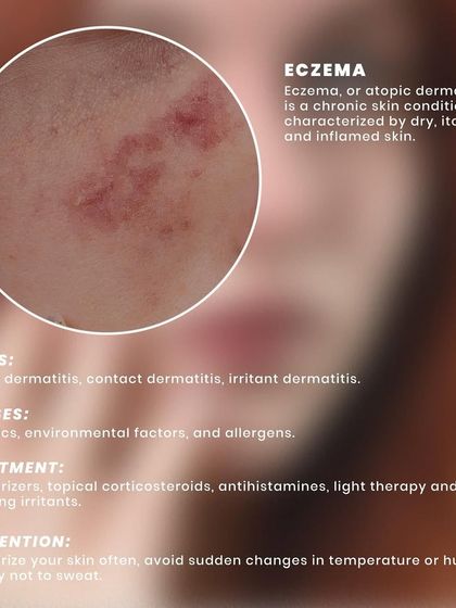 Eczema, or atopic dermatitis, is a chronic condition causing dry, itchy, and inflamed skin. It can be managed with moisturizers, topical corticosteroids, and by avoiding environmental irritants.