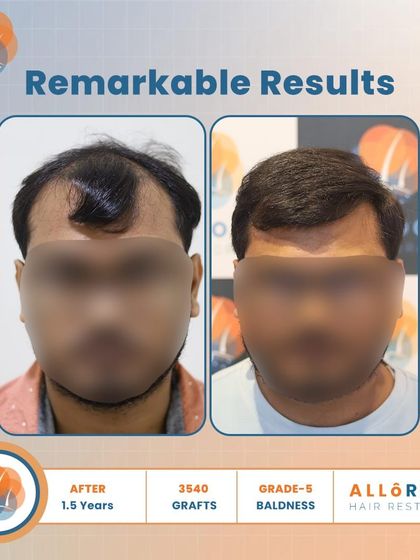 Remarkable results after 1.5 years for a Grade 5 baldness case. Using 3540 grafts, we achieved a dense and natural-looking outcome, as shown in these detailed before-and-after shots.
