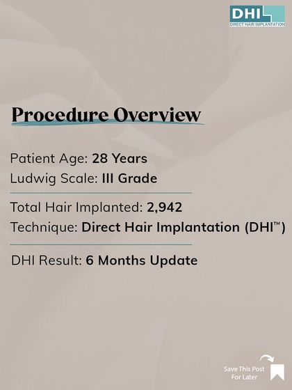 This card provides an overview of the female hair restoration procedure, detailing the patient's age (28), Ludwig Scale (III), total hair implanted (2,942), and the 6-month update.