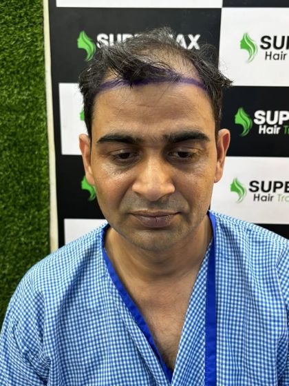 A frontal view of the client before the procedure, with the new hairline drawn to frame the face perfectly.