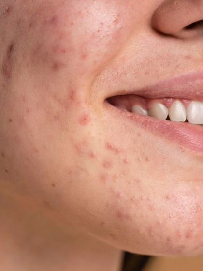 This close-up shows a patient dealing with active acne and residual scarring. My goal here is a two-step approach: first, to control the breakouts, and second, to begin a gentle scar revision process.