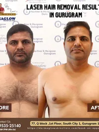 Laser Hair Removal