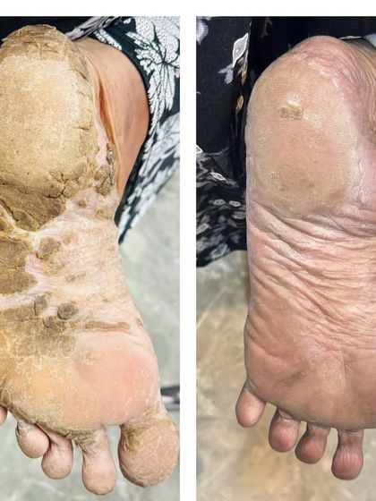 Another Look at Healing Cracked Heels. This is a different angle of the successful treatment for Palmoplantar Keratoderma, emphasizing the complete restoration of the skin on the sole of the foot.