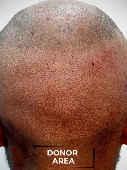 Skinmatics - Hair Restoration FUE Hair Transplant: Results & Transformations photo 9