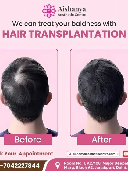 For advanced hair loss, a hair transplant can be a life-changing solution. Here is a clear example of how I create a natural, dense hairline, permanently restoring hair to a previously bald area.