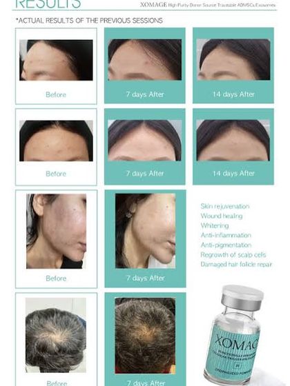 These before and after images show the results of Exosome therapy for both skin rejuvenation and hair regrowth. This advanced treatment activates stem cells and delivers growth factors to repair damaged follicles and promote new growth.