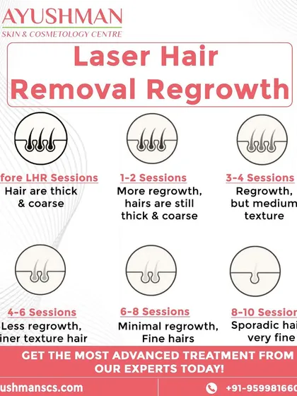 We believe in setting clear expectations for your laser hair removal journey. This guide shows the typical progression from thick hair to finer, sporadic regrowth over 8 to 10 sessions, leading to long-lasting smooth skin.