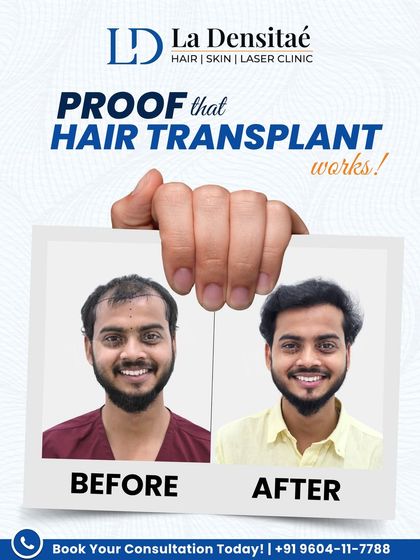 YouTuber GOGO (Shubham Verma) chose my clinic for his hair loss solution. Months later, his smile reflects his relief and confidence. His result is more proof that hair transplants really work.