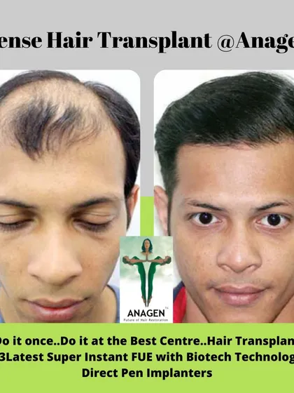"Do it once..Do it at the Best Centre." This before and after photo shows a dense hair transplant result that justifies our motto.