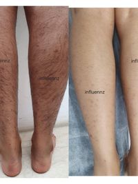 Laser Hair & Tattoo Removal