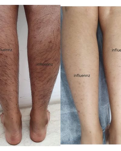 Laser Hair & Tattoo Removal