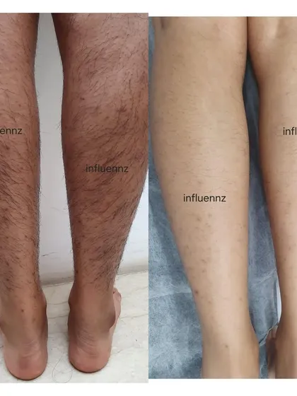 This is a real result after seven sessions of laser hair removal on the legs. You can see a significant reduction in hair density and thickness, along with a noticeable improvement in skin texture. The "strawberry skin" appearance caused by shaving is also greatly reduced.