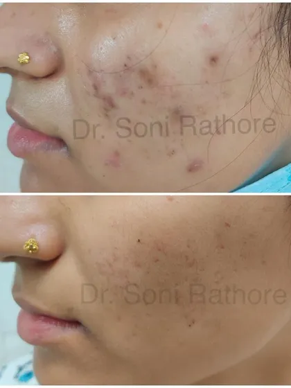 This before and after photo shows the successful completion of step one: treating active acne. You can see a dramatic reduction in inflammation and breakouts. Now, we can begin to focus on the post-inflammatory marks.