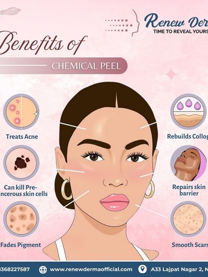 This graphic explains the benefits of a chemical peel. This treatment is a fantastic solution for treating acne, fading pigment, smoothing scars, repairing the skin barrier, and rebuilding collagen for a healthier, more even complexion.