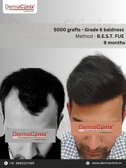 This before and after image shows the result of a 5000 graft B.E.S.T. FUE procedure for a patient with Grade 6 baldness. The nine month result demonstrates our capability to handle advanced stages of hair loss and deliver comprehensive, natural looking coverage.