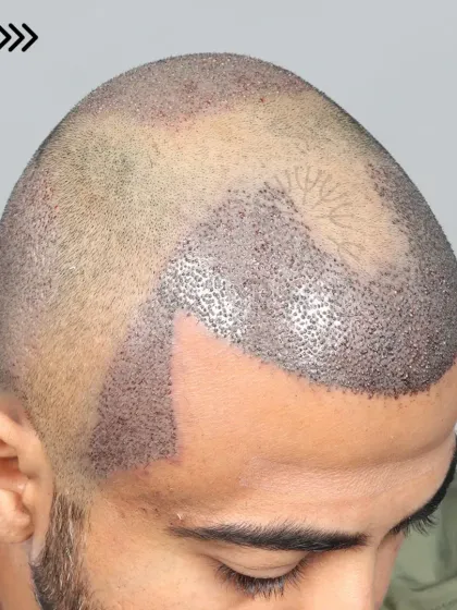 A fresh after-surgery look for a Norwood Grade 5 case. 5500 grafts were used to restore the hairline, frontal region, and crown.