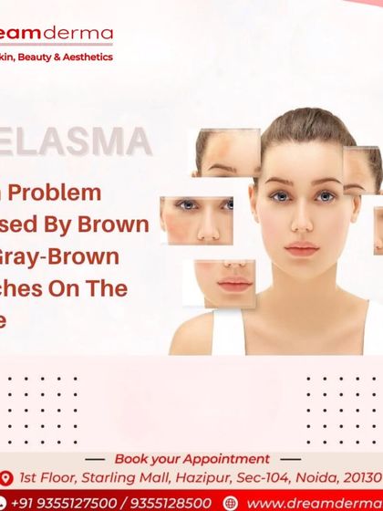 Melasma is a common skin problem that causes brown to gray-brown patches on the face. We offer specialized treatments to manage this condition and help restore an even skin tone.