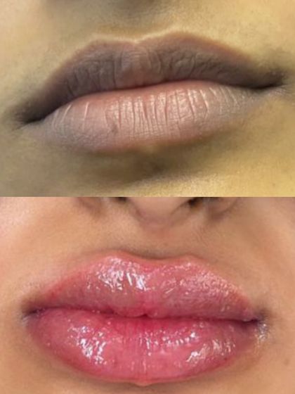 This before and after shot highlights how lip blush can create the appearance of fuller, more hydrated lips while correcting pigmentation.