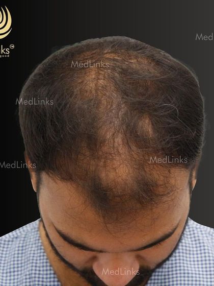 A top-down view of the patient's hair loss before the transplant.