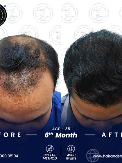 A top-down view at 6 months, demonstrating the extensive coverage and density achieved with the BIO FUE technique.