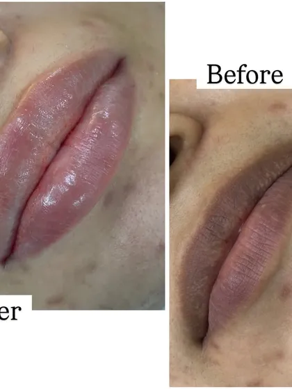 For anyone with pigmented lips, lip neutralization is a game changer. This before and after shows how I corrected the darker tones to create a healthy, even, and naturally pink pout.