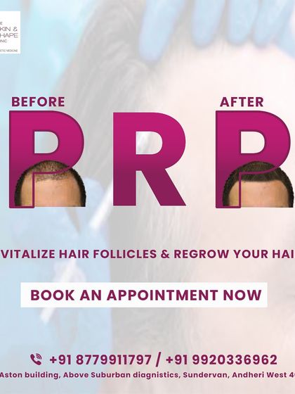 This before and after demonstrates the power of PRP therapy. By using the client's own growth factors, we revitalized the hair follicles, leading to a fuller hairline and denser hair. This is a non-surgical approach to effectively regrow your hair.