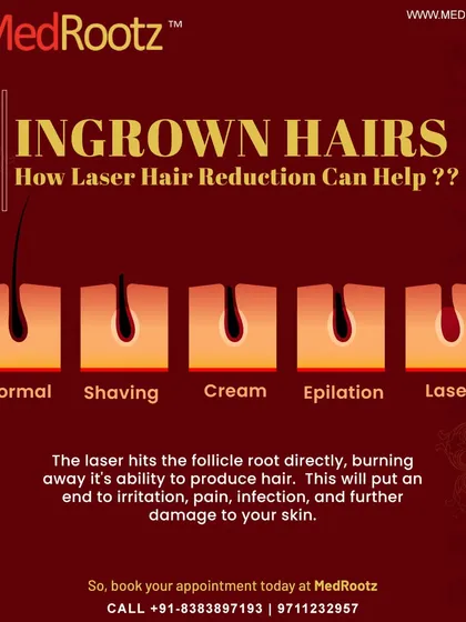 Many of my patients struggle with ingrown hairs from shaving or waxing. This diagram shows how laser treatment is the superior solution. By targeting the hair follicle root directly, the laser prevents the hair from growing back, which puts an end to the irritation, pain, and potential scarring caused by ingrowns.