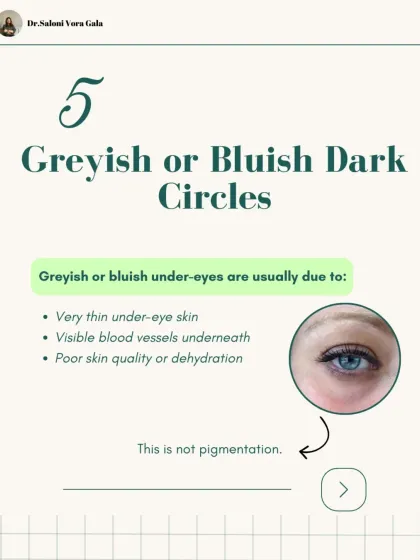 Greyish or bluish dark circles are usually not a sign of pigmentation. This is typically caused by very thin under-eye skin, which makes the blood vessels underneath more visible.