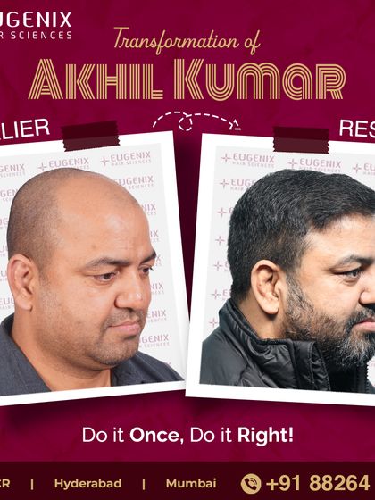 See the powerful transformation of former international boxer Akhil Kumar, who notes the procedure gave him a softer, more approachable look.