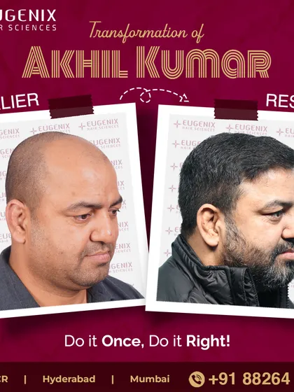 See the powerful transformation of former international boxer Akhil Kumar, who notes the procedure gave him a softer, more approachable look.