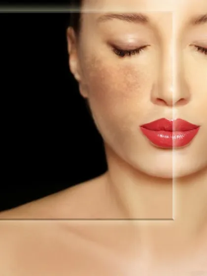 This image illustrates the dramatic difference a targeted pigmentation treatment can make. My goal is to not only clear the existing spots but also to improve the skin's overall health and radiance.
