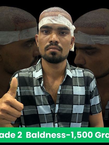 A Grade 2 baldness case treated with 1500 grafts. We handle all levels of hair loss with precision.