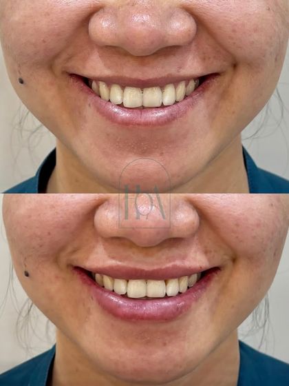 Notice the beautiful, natural curve of the smile after a lip filler treatment. The enhancement is subtle, designed to complement her features and provide a hydrated, healthy appearance without looking overdone.