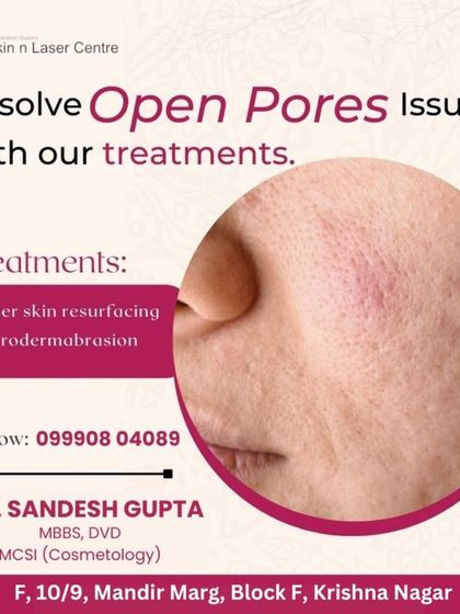 Open pores can be resolved with treatments like laser skin resurfacing and microdermabrasion. This graphic shows a close-up of enlarged pores, a common issue I effectively treat at my clinic.