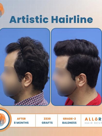 An artistic hairline is key to a natural result. This 8-month result for Grade 2 baldness, using 2330 grafts, shows how I meticulously design the hairline to be soft and irregular, avoiding a fake, pluggy look.