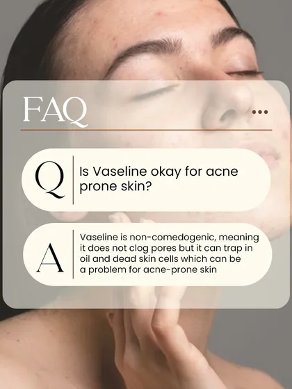 A common question: Is Vaseline okay for acne-prone skin? It is non-comedogenic, but it can trap oil and dead skin cells, which can be a problem for some.
