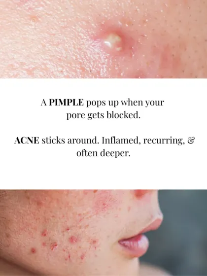 A pimple is a blocked pore, but acne is a recurring, inflammatory condition. My Anti-Acne Face Wash is formulated to address the root cause of acne, helping to soothe and restore balance.