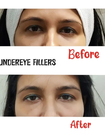 This before-and-after image clearly shows the results of our under-eye filler treatment. We effectively reduced the appearance of hollows and dark circles, resulting in a brighter, more rested, and rejuvenated look for our client.