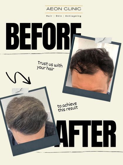 Trusting us with your hair means trusting a process that delivers. This result shows a restored hairline and improved overall coverage.